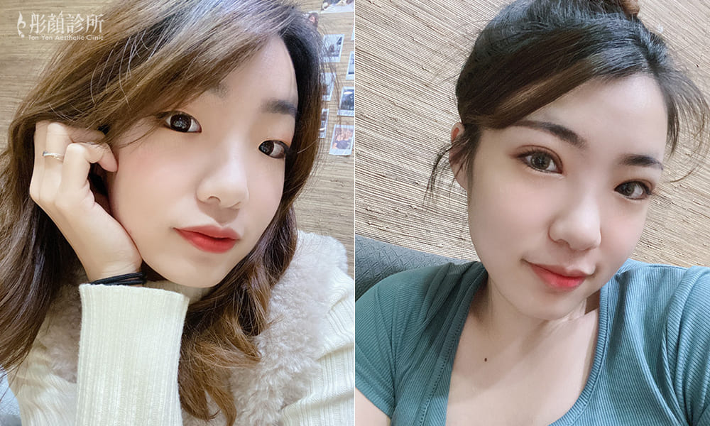 割雙眼皮-提眼瞼肌-彤顏雙眼皮-開眼頭-眼神放大術-眼瞼肌無力-陳彥瑋醫師-割雙眼皮手術前後對比-雙眼皮手術