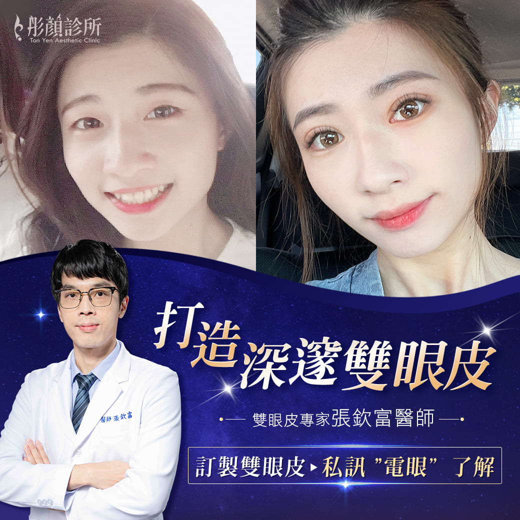 雙眼皮手術前後對比照片-彤顏診所-雙眼皮-訂書針雙眼皮-桃園雙眼皮-中壢雙眼皮-提眼瞼肌-割雙眼皮-雙眼皮手術