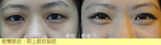 泡泡眼-割雙眼皮-開眼頭-雙眼皮手術