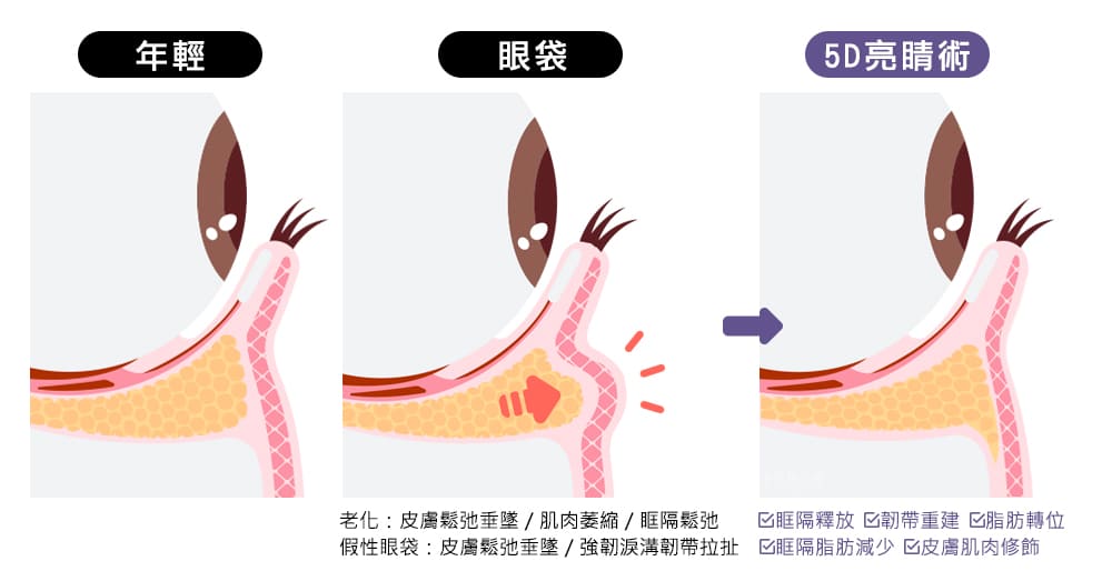 5D亮睛術-隱痕眼袋-眼袋手術-淚溝-黑眼圈-眼袋-中壢醫美-桃園醫美-眼袋如何消除