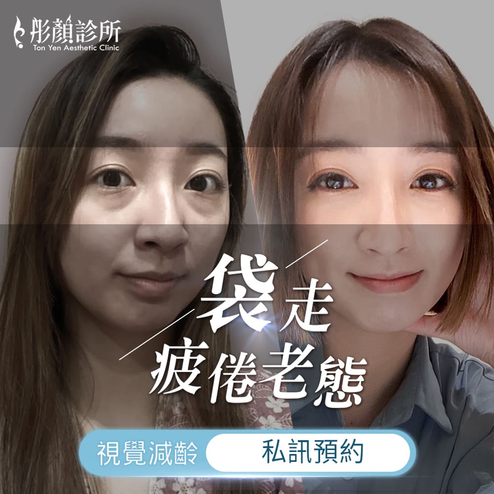 眼袋-5D亮睛術-眼袋手術-眼袋推薦-眼袋手術推薦-中壢醫美-桃園醫美