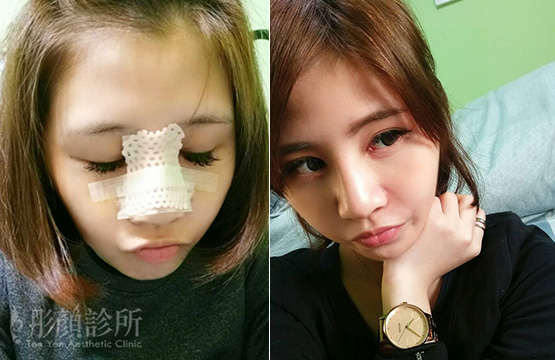 隆鼻-立體結構式隆鼻-卡麥拉隆鼻-縮鼻翼-大韓隆鼻-結構式隆鼻-劉宏貞醫師-中壢隆鼻-彤顏診所-整形外科-蒜頭鼻