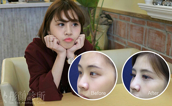 隆鼻-立體結構式隆鼻-卡麥拉隆鼻-縮鼻翼-大韓隆鼻-結構式隆鼻-劉宏貞醫師-中壢隆鼻-彤顏診所-整形外科-蒜頭鼻