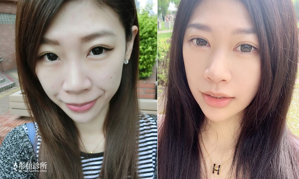 隆鼻-立體結構式隆鼻-陳彥瑋醫師-卡麥拉隆鼻-縮鼻翼-大韓隆鼻-結構式隆鼻-彤顏診所-整形外科-中壢隆鼻-蒜頭鼻