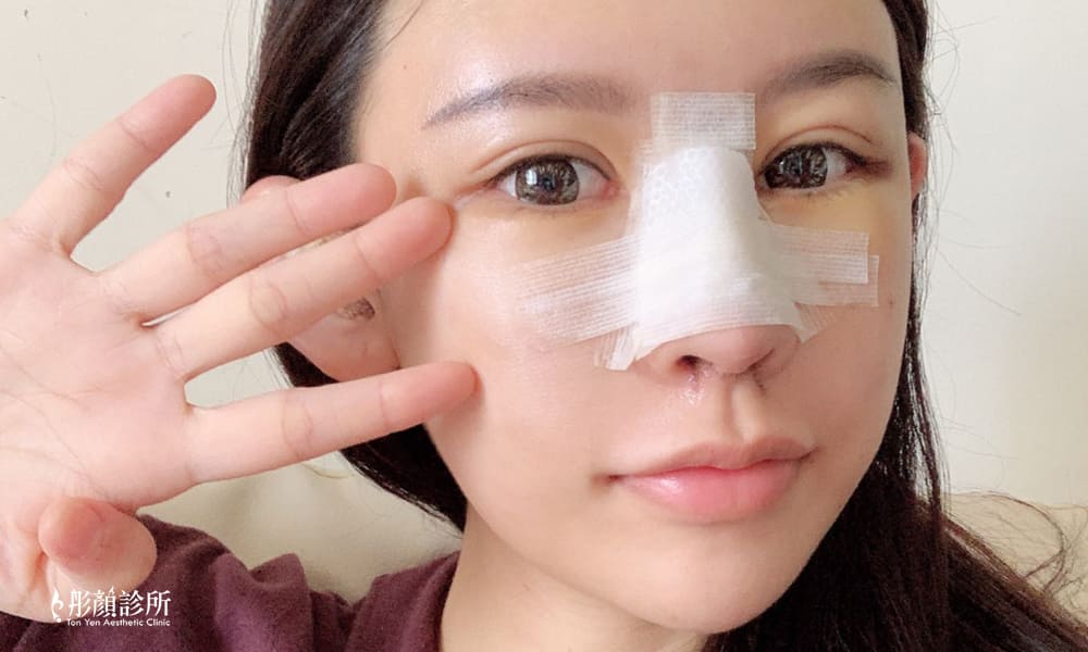 隆鼻-立體結構式隆鼻-陳彥瑋醫師-卡麥拉隆鼻-縮鼻翼-大韓隆鼻-結構式隆鼻-彤顏診所-整形外科-中壢隆鼻-蒜頭鼻