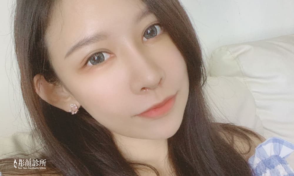 隆鼻-立體結構式隆鼻-陳彥瑋醫師-卡麥拉隆鼻-縮鼻翼-大韓隆鼻-結構式隆鼻-彤顏診所-整形外科-中壢隆鼻-蒜頭鼻