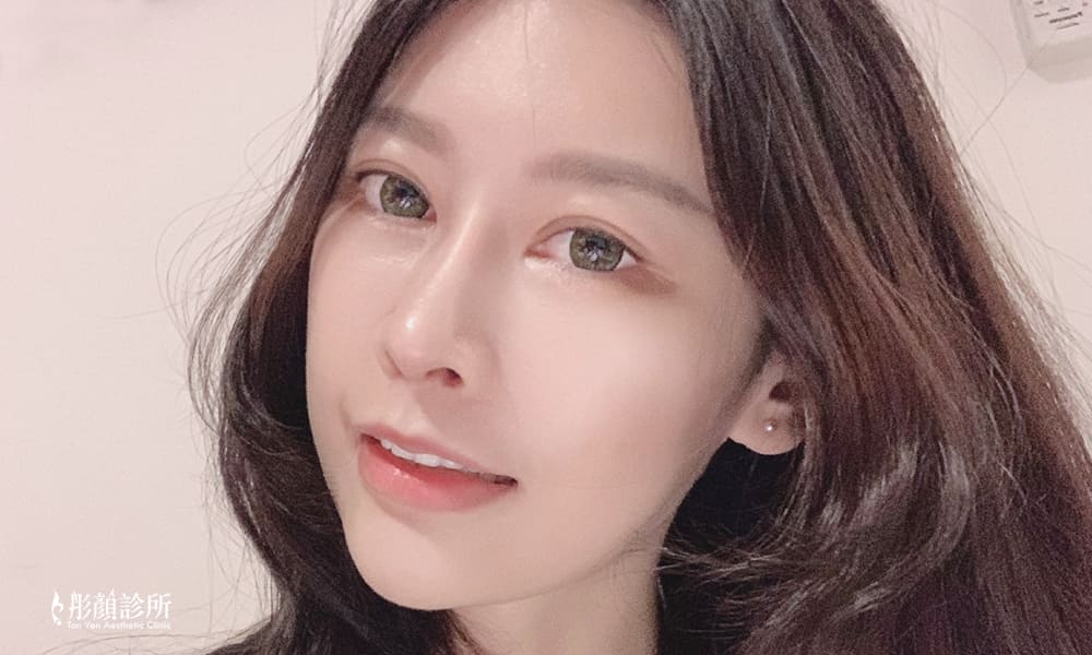 隆鼻-立體結構式隆鼻-陳彥瑋醫師-卡麥拉隆鼻-縮鼻翼-大韓隆鼻-結構式隆鼻-彤顏診所-整形外科-中壢隆鼻-蒜頭鼻