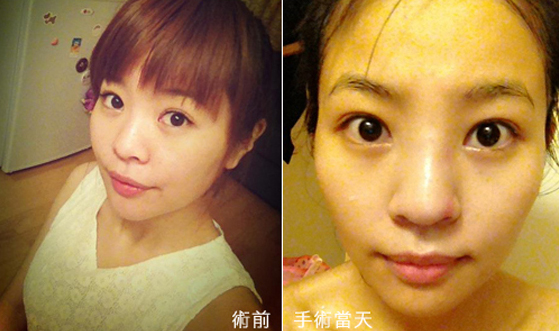 隆鼻-立體結構式隆鼻-卡麥拉隆鼻-縮鼻翼-大韓隆鼻-結構式隆鼻-彤顏診所-整形外科-蒜頭鼻-劉宏貞醫師-隆鼻價格-隆鼻費用