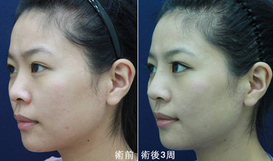 隆鼻-立體結構式隆鼻-卡麥拉隆鼻-縮鼻翼-大韓隆鼻-結構式隆鼻-彤顏診所-整形外科-蒜頭鼻-劉宏貞醫師-隆鼻價格-隆鼻費用-晶亮瓷-微晶瓷