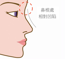 隆鼻-立體結構式隆鼻-卡麥拉隆鼻-縮鼻翼-大韓隆鼻-結構式隆鼻-彤顏診所-整形外科-蒜頭鼻-劉宏貞醫師-隆鼻價格-隆鼻費用