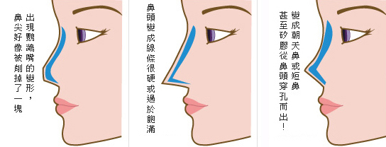 隆鼻-立體結構式隆鼻-卡麥拉隆鼻-縮鼻翼-大韓隆鼻-結構式隆鼻-彤顏診所-整形外科-蒜頭鼻-劉宏貞醫師-隆鼻價格-隆鼻費用