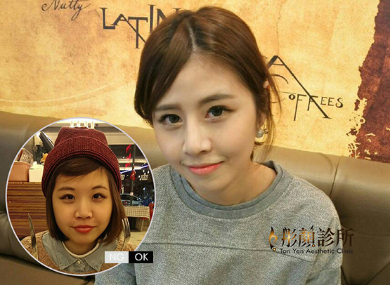 隆鼻-立體結構式隆鼻-劉宏貞醫師-卡麥拉隆鼻-縮鼻翼-大韓隆鼻-結構式隆鼻-彤顏診所-整形外科-中壢隆鼻-蒜頭鼻