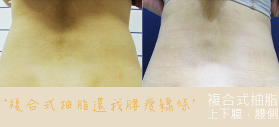彤顏診所-複合式抽脂-抽脂-水刀抽脂-曲線雕塑-脂雕-體雕-瘦身-塑身