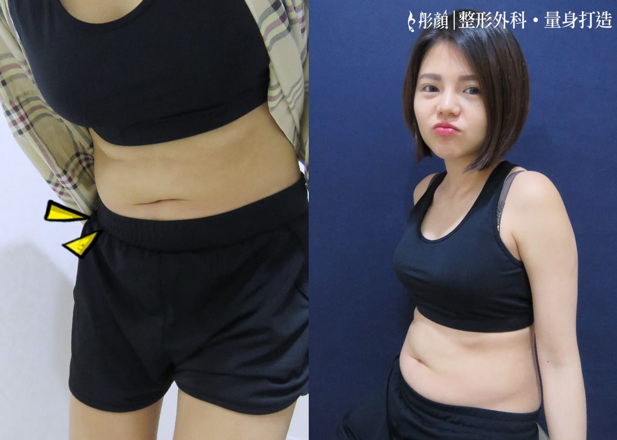 彤顏診所-複合式抽脂-抽脂-醫美抽脂-瘦身-桃園抽脂推薦-桃園抽脂