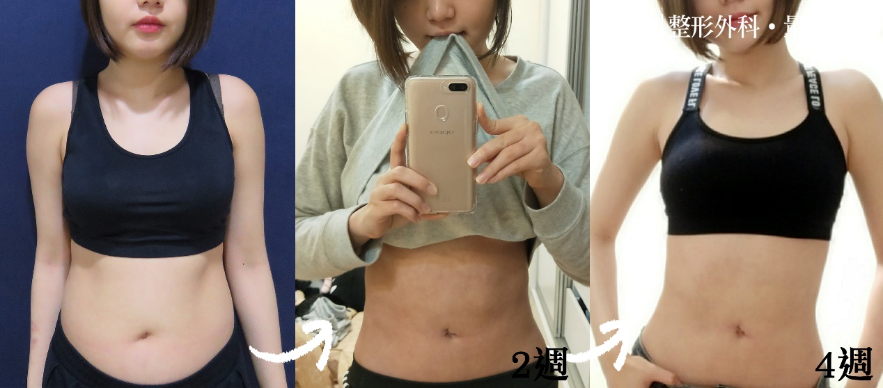 彤顏診所-複合式抽脂-抽脂-腹部抽脂效果前後比對-醫美抽脂-瘦身-桃園抽脂推薦-瘦身-桃園抽脂