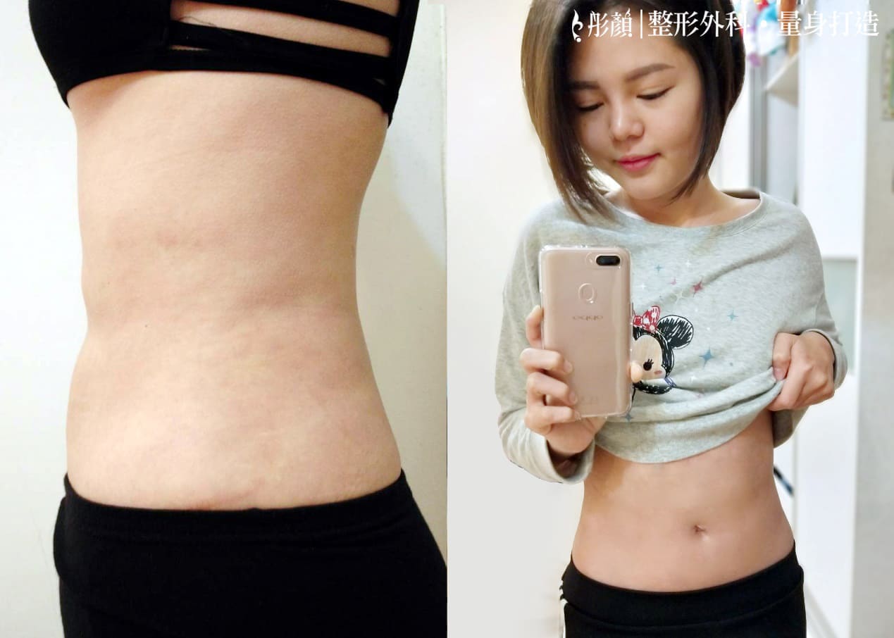 彤顏診所-複合式抽脂-腹部抽脂-醫美抽脂-瘦身-桃園抽脂推薦-瘦身-桃園抽脂