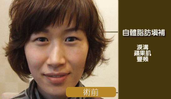 彤顏診所-自體脂肪隆乳-豐頰-自體脂肪補脂-豐胸-自體脂肪填補-全臉補脂-豐額頭-補脂
