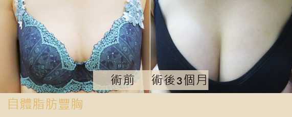 彤顏診所-自體脂肪隆乳-豐頰-自體脂肪補脂-豐胸-自體脂肪填補-全臉補脂-豐額頭