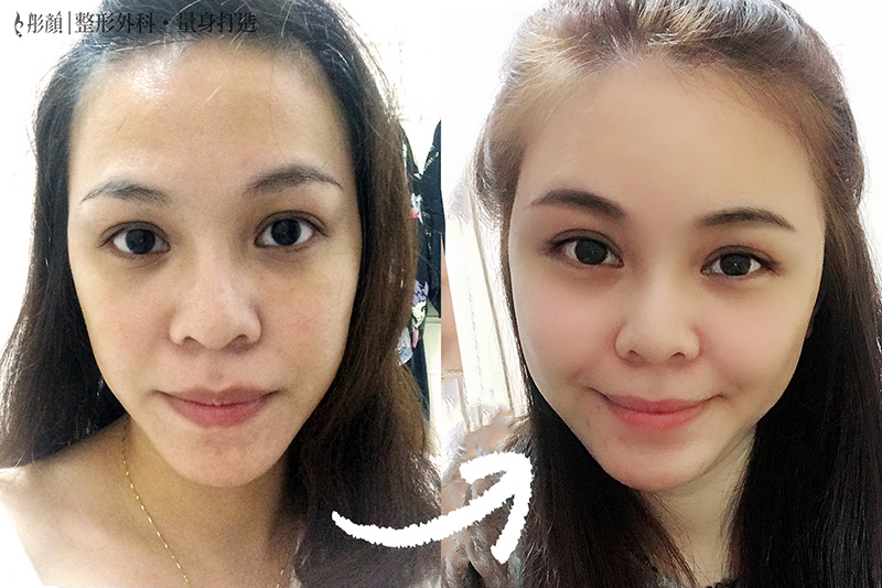 彤顏診所-自體脂肪隆乳-豐頰-自體脂肪補脂-豐胸-自體脂肪填補-全臉補脂-豐額頭-八德整形外科-八德補脂