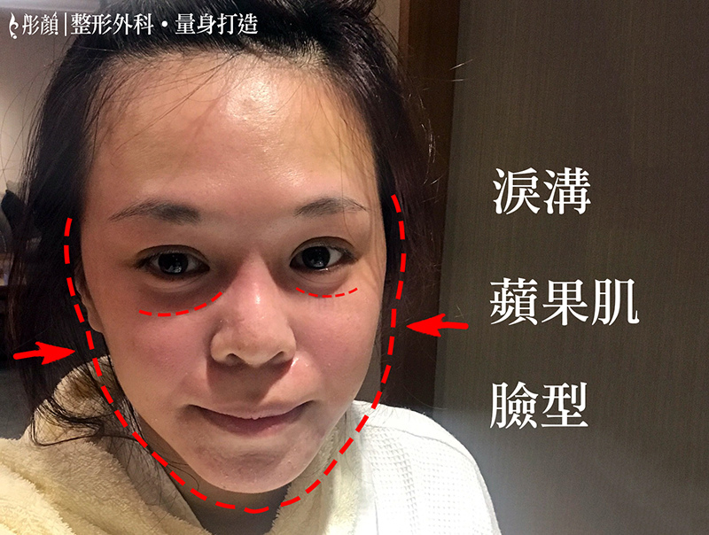 彤顏診所-自體脂肪隆乳-豐頰-自體脂肪補脂-豐胸-自體脂肪填補-全臉補脂-豐額頭-補脂