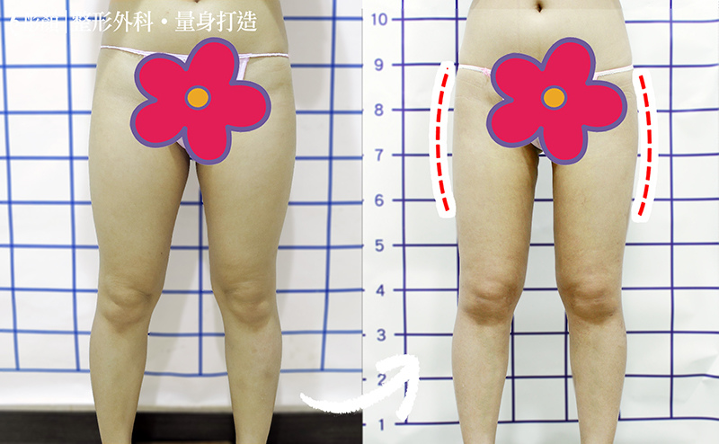 彤顏診所-自體脂肪隆乳-豐頰-自體脂肪補脂-豐胸-自體脂肪填補-全臉補脂-豐額頭-補脂