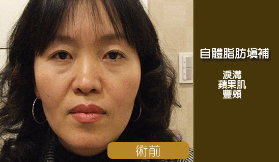 彤顏診所-自體脂肪隆乳-豐頰-自體脂肪補脂-豐胸-自體脂肪填補-全臉補脂-豐額頭-補脂