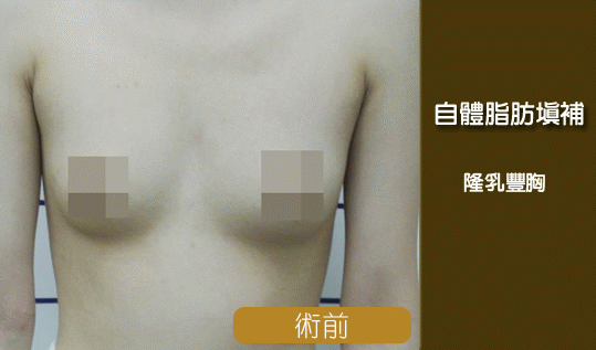 彤顏診所-自體脂肪隆乳-豐頰-自體脂肪補脂-豐胸-自體脂肪填補-全臉補脂-豐額頭-補脂