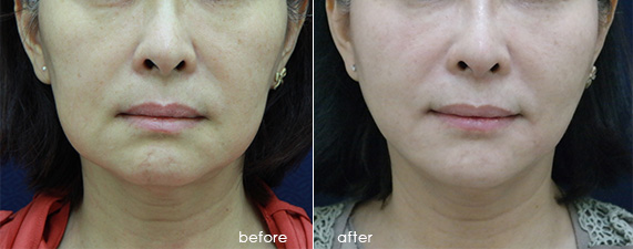 輪廓拉提-面部拉提-線雕拉提-中下臉拉提