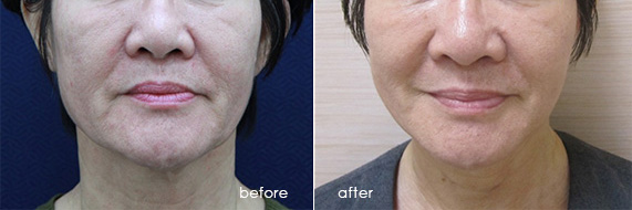 輪廓拉提-面部拉提-線雕拉提-中下臉拉提