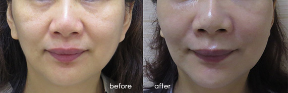 輪廓拉提-面部拉提-線雕拉提-中下臉拉提