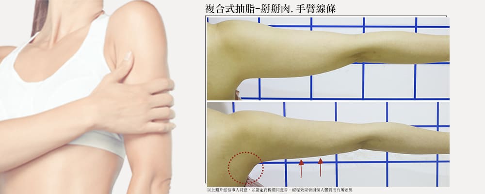 彤顏診所-複合式抽脂-抽脂前後比對-體雕-手臂抽脂前後比對
