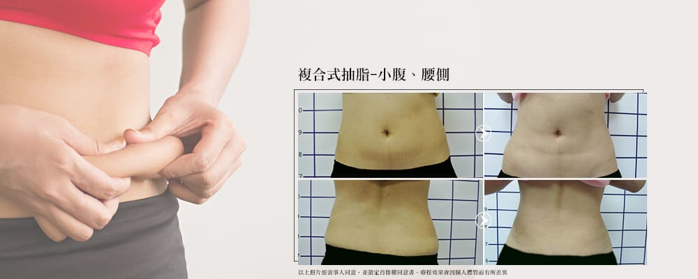 彤顏診所-複合式抽脂前後比對-抽脂-腰腹抽脂前後比對-腰腹抽脂手術效果