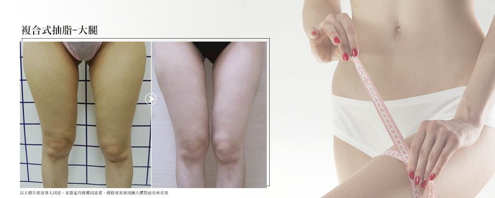 彤顏診所-複合式抽脂-抽脂-抽脂效果前後比對-體雕-大腿抽脂效果-大腿抽脂推薦
