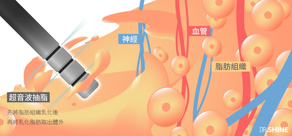 彤顏診所-複合式抽脂-抽脂-黃金z波-超音波抽脂-腰腹抽脂-掰掰袖抽脂-大腿抽脂-抽脂手術-全身抽脂