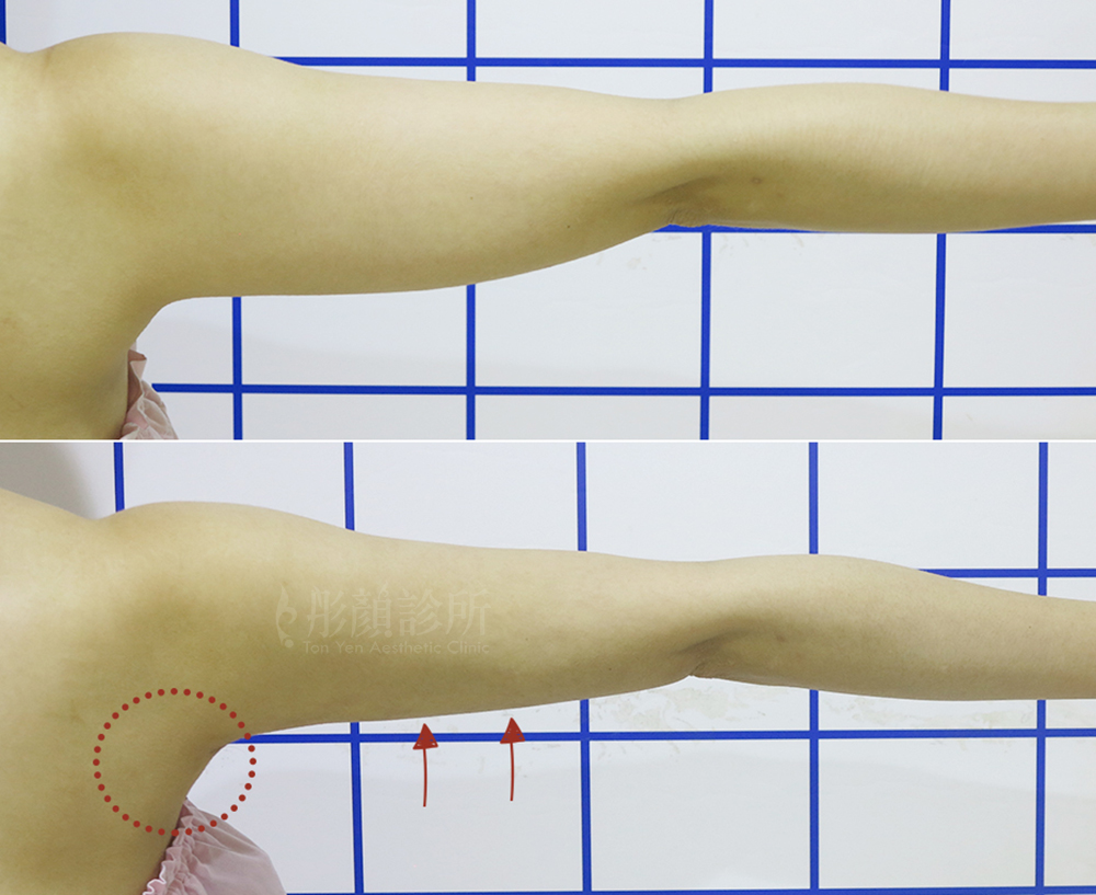 彤顏診所-複合式抽脂-抽脂-手臂抽脂前後效果比對-蝴蝶袖-副乳-八德抽脂推薦-桃園抽脂診所推薦