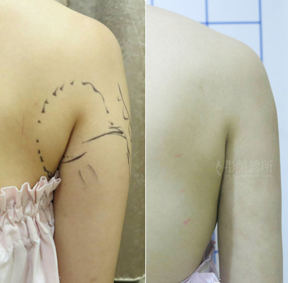 彤顏診所-複合式抽脂-抽脂-手臂抽脂-瘦身-蝴蝶袖抽脂-副乳抽脂