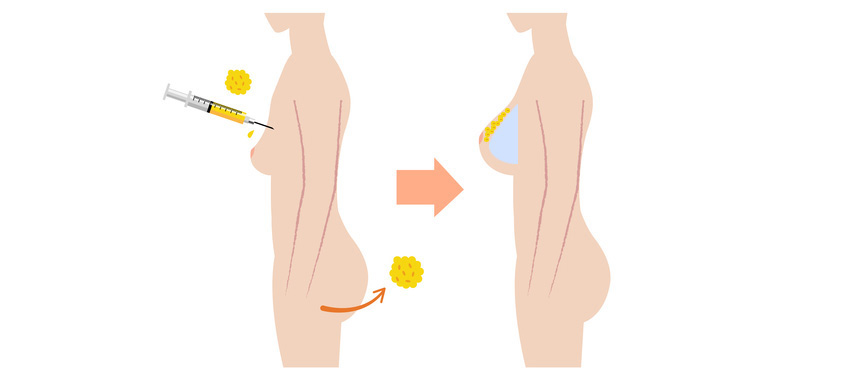 彤顏診所-果凍隆乳-果凍矽膠隆乳-蜜桃果凍隆乳-水滴絨毛果凍隆乳-隆乳手術-水滴隆乳-隆乳光滑
