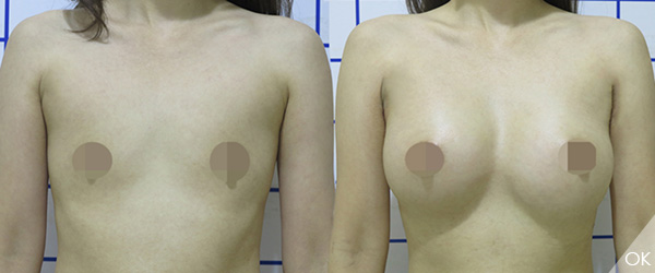 彤顏診所-果凍隆乳-果凍矽膠隆乳-蜜桃果凍隆乳-水滴絨毛果凍隆乳-隆乳手術-內視鏡-劉宏貞-整形外科-隆乳光滑面-水滴隆乳