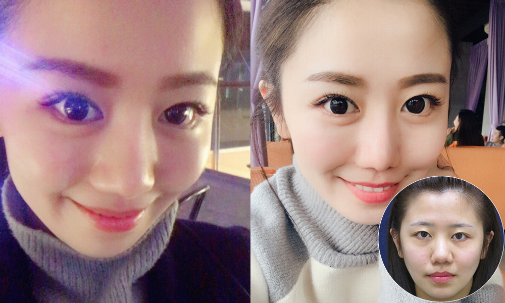 彤顏診所-隆鼻-黃金比例-立體結構式隆鼻-隆鼻價格-結構式隆鼻-隆鼻推薦-隆鼻手術-韓式隆鼻-卡麥拉隆鼻-整形外科-縮鼻翼-蒜頭鼻-桃園隆鼻-中壢隆鼻-隆鼻費用