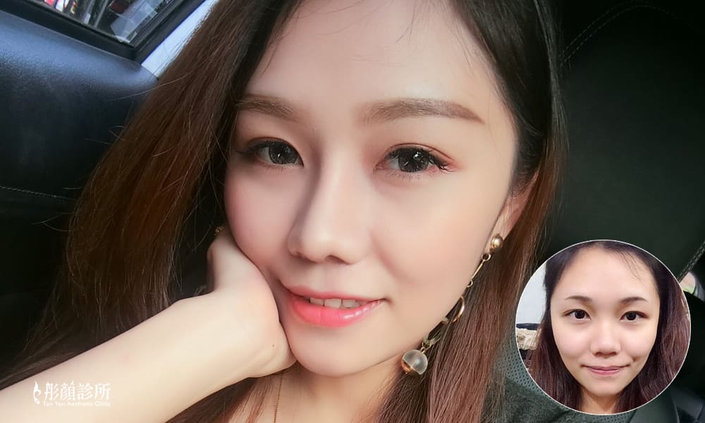 隆鼻-立體結構式隆鼻-彤顏診所-隆鼻價格-結構式隆鼻-隆鼻推薦-隆鼻手術-韓式隆鼻-卡麥拉隆鼻-整形外科-縮鼻翼-蒜頭鼻-桃園隆鼻-中壢隆鼻-隆鼻費用
