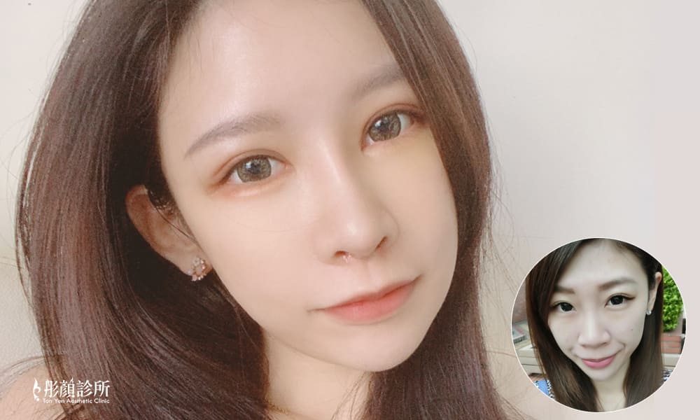 隆鼻-立體結構式隆鼻-彤顏診所-隆鼻價格-結構式隆鼻-隆鼻推薦-隆鼻手術-韓式隆鼻-卡麥拉隆鼻-整形外科-縮鼻翼-蒜頭鼻-桃園隆鼻-中壢隆鼻-隆鼻費用