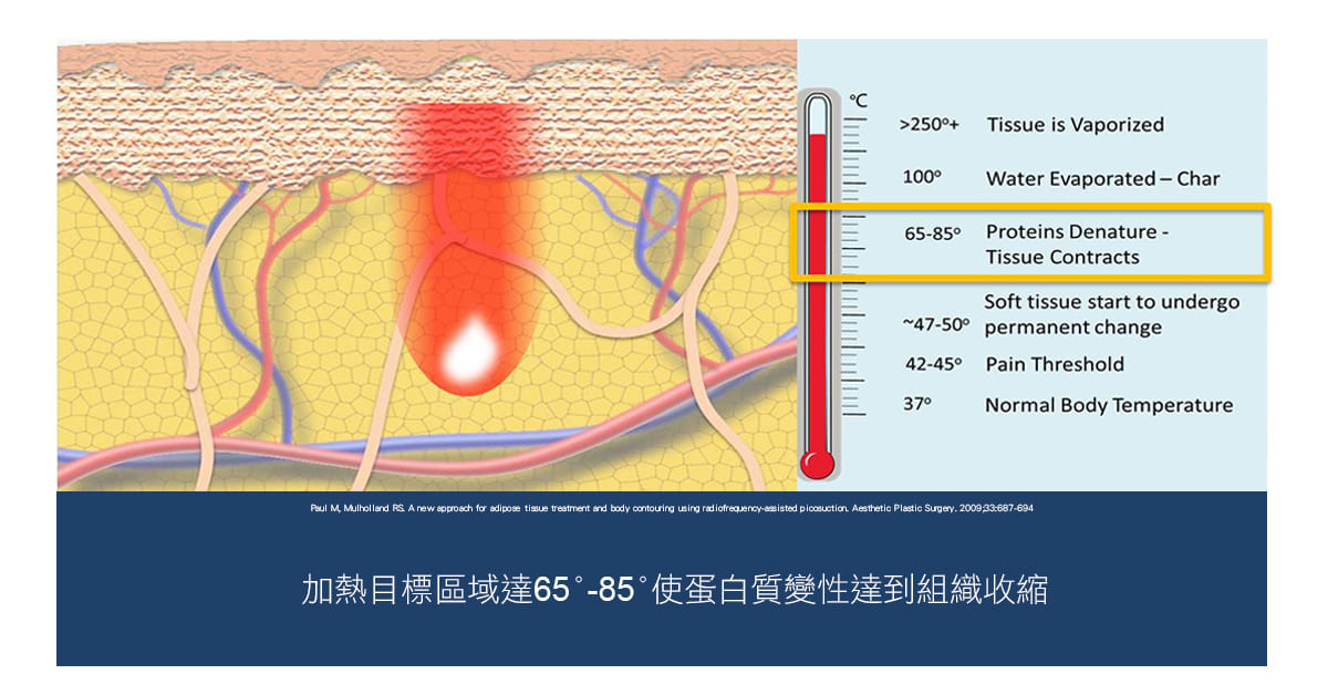 超能電漿-電漿縮皮-電漿抽脂