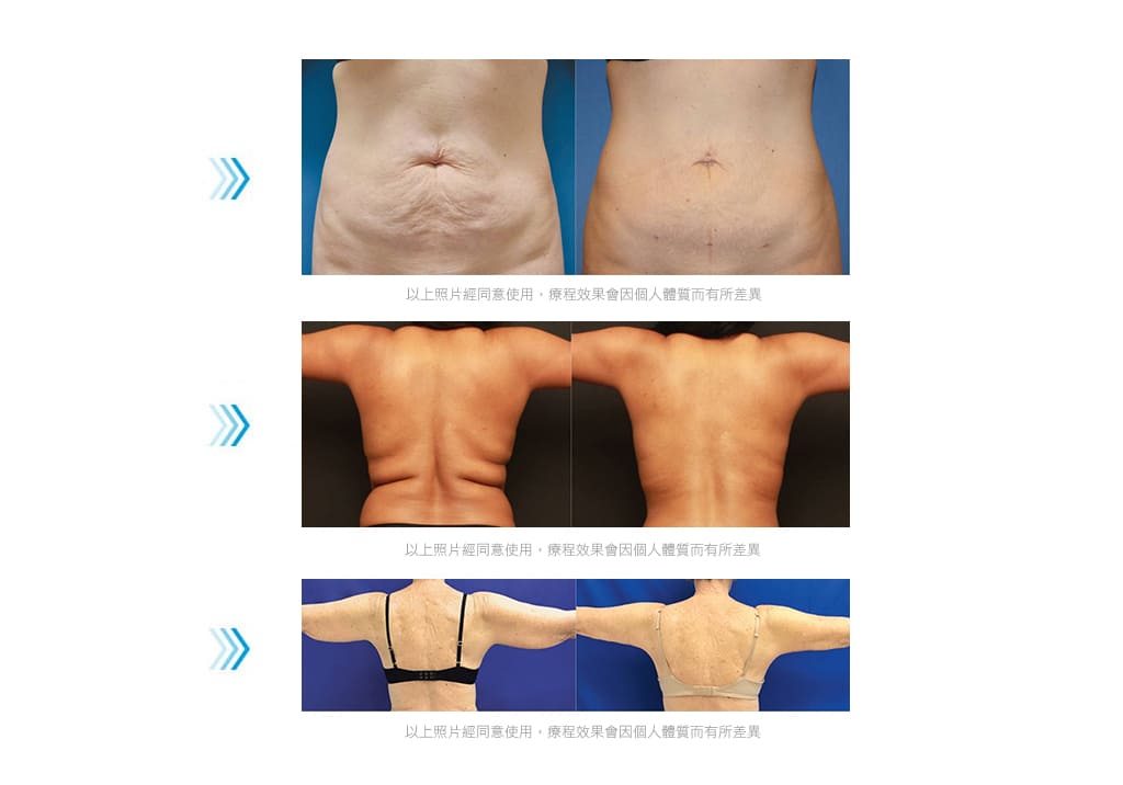 腹部拉皮-超能電漿-電漿縮皮-電漿抽脂-超能電漿縮皮手術