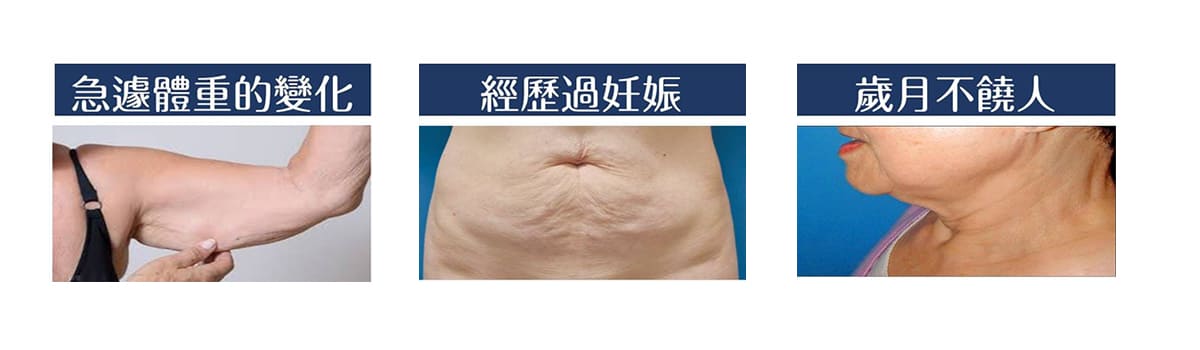 超能電漿-電漿縮皮-電漿抽脂-腹部拉皮