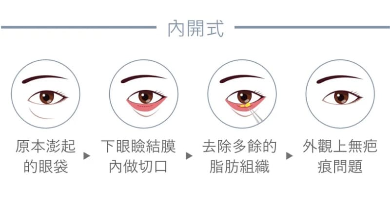 眼袋-眼袋手術-眼袋成因-眼袋費用-眼袋內開-眼袋外開-5D亮睛術-眼袋消除-眼袋原因