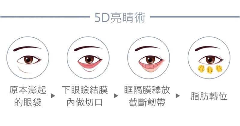 眼袋-眼袋手術-眼袋成因-眼袋費用-眼袋內開-眼袋外開-5D亮睛術-眼袋消除-眼袋原因