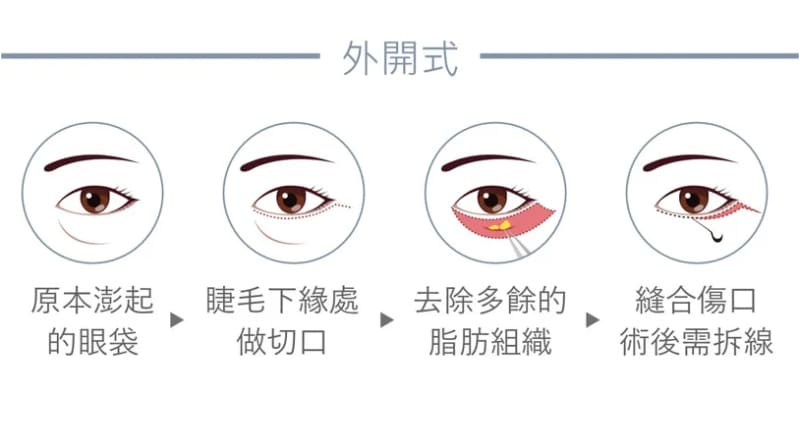 眼袋-眼袋手術-眼袋成因-眼袋費用-眼袋內開-眼袋外開-5D亮睛術-眼袋消除-眼袋原因