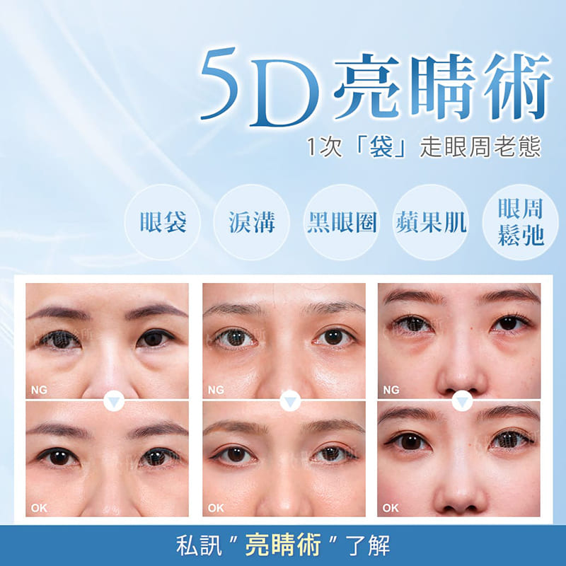 眼袋-眼袋手術-眼袋成因-眼袋費用-眼袋內開-眼袋外開-5D亮睛術-眼袋消除-眼袋原因