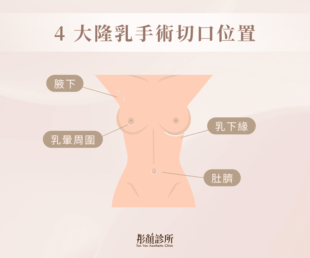 4大隆乳手術切口位置示意圖：腋下、乳暈周圍、乳下緣、肚臍