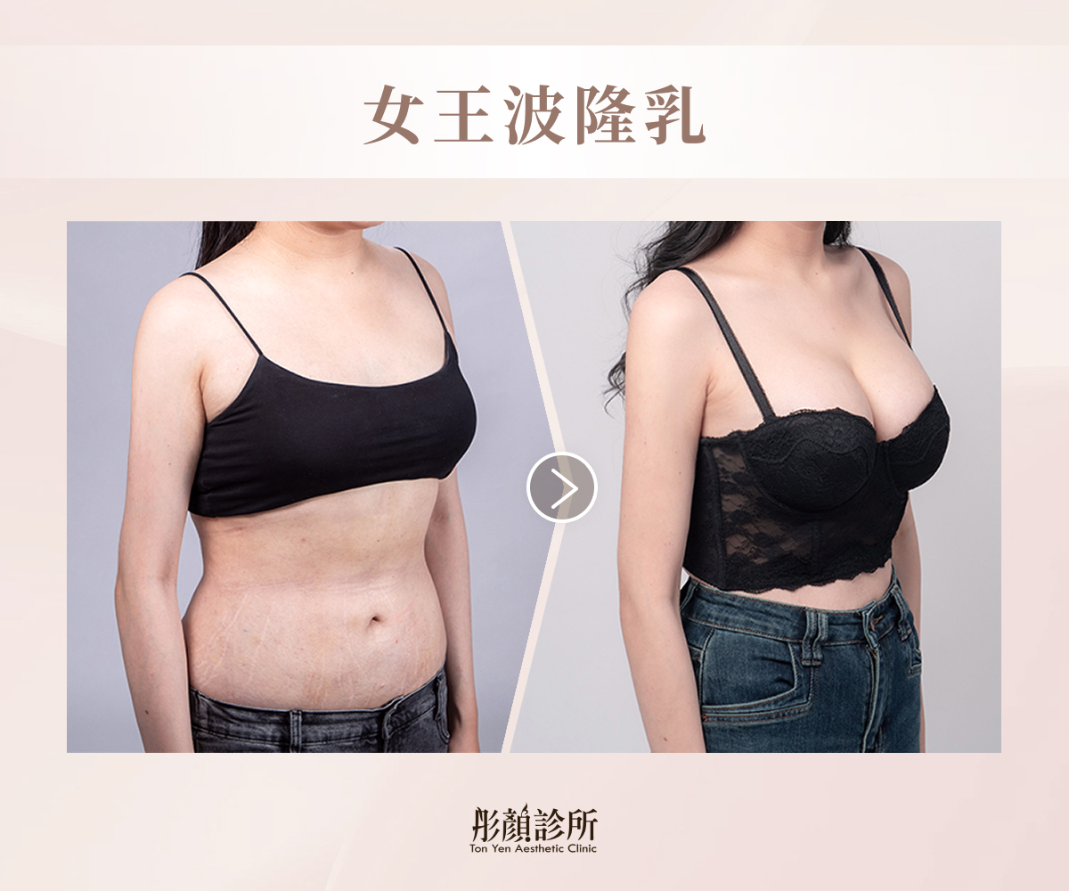 女王波隆乳案例一術前術後對比照